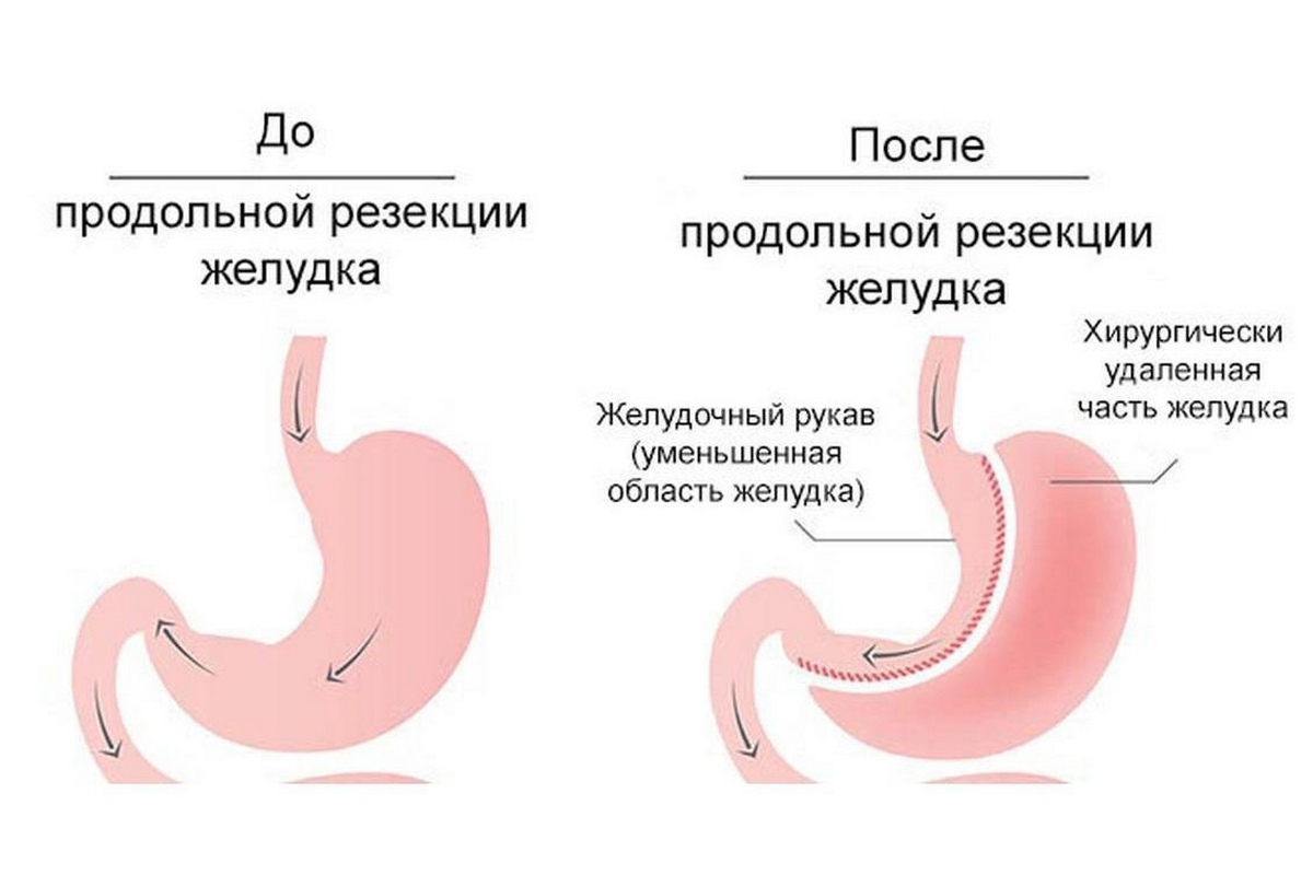 Последствия операции желудка